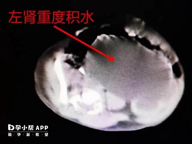 10号染色体微重复宝宝会出现肾积水