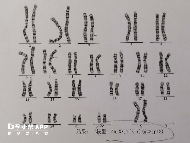 染色体46Xx14pss说明14号染色体异常