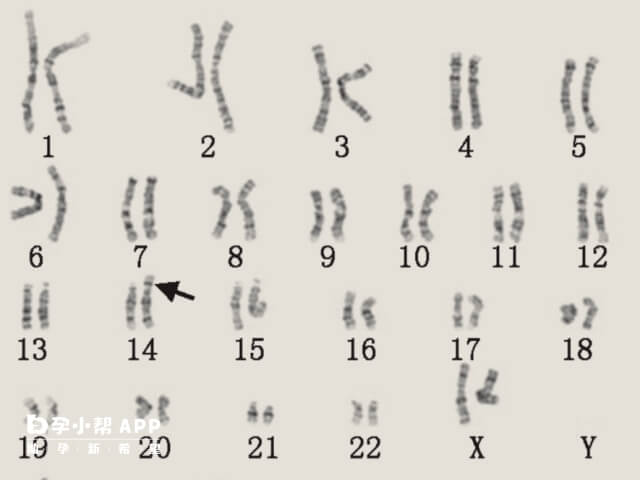 胎儿14号染色体长臂重复的病例多