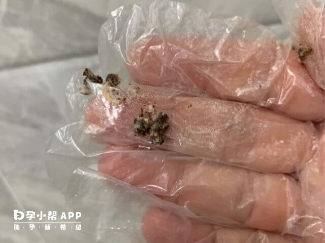 宫颈受损雪诺酮药渣会呈黑褐色